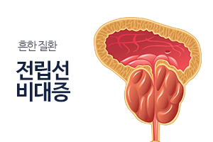 전립선비대증